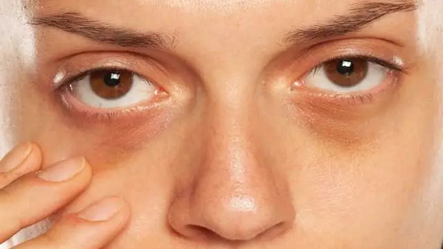 Dark Circles Kaise Hataye: 1 ही रात मे छूमंतर होंगे आंखों के काले घेरे, जानें इसके असरदार घरेलू नुस्खे